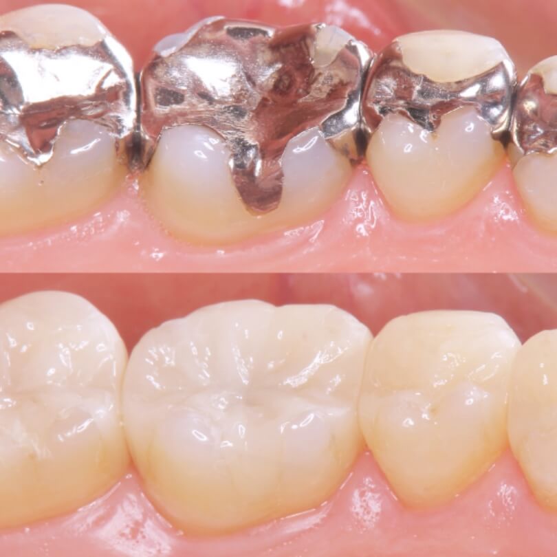 インレー・オンレー