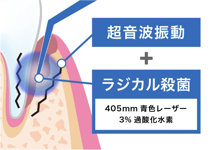 ブルーラジカル治療