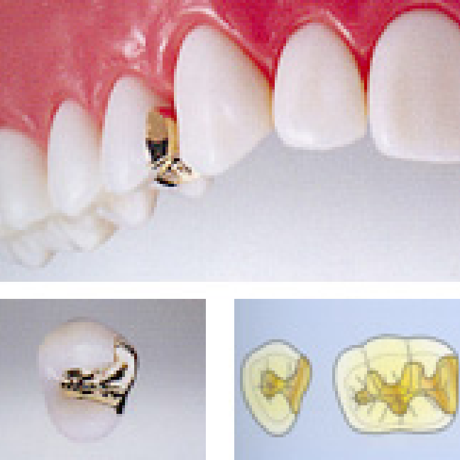 ゴールドインレー