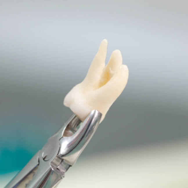 親知らずの抜歯