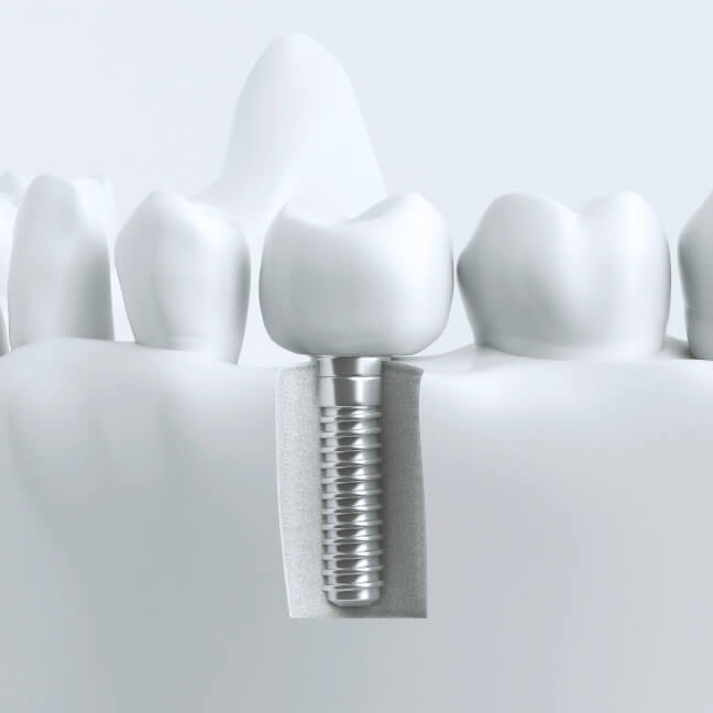 インプラントとの違い