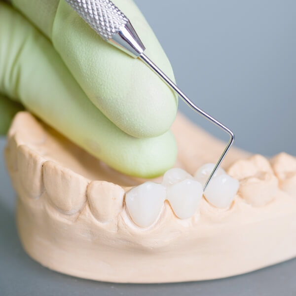従来のブリッジとの違い
