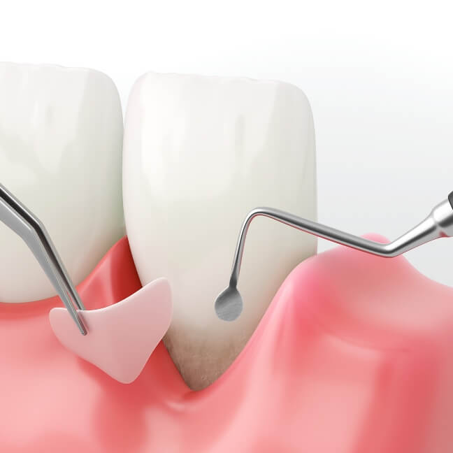 ルートプレーニング