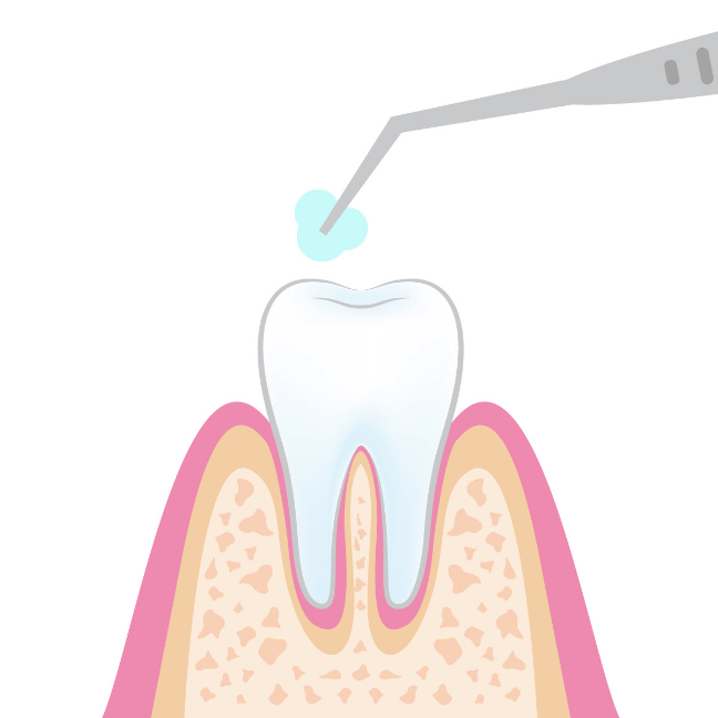 歯仕上げのフッ素塗布