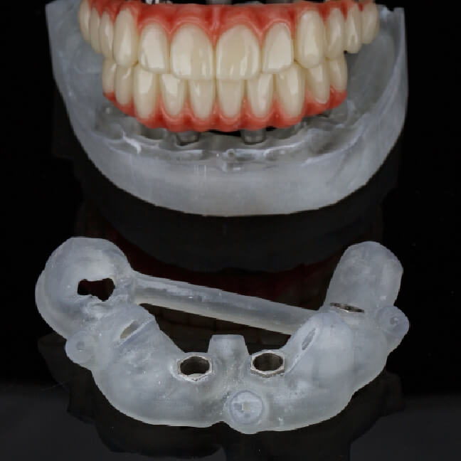 CBCT one guide インプラント