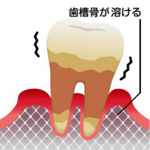 後期段階（重度歯周炎）