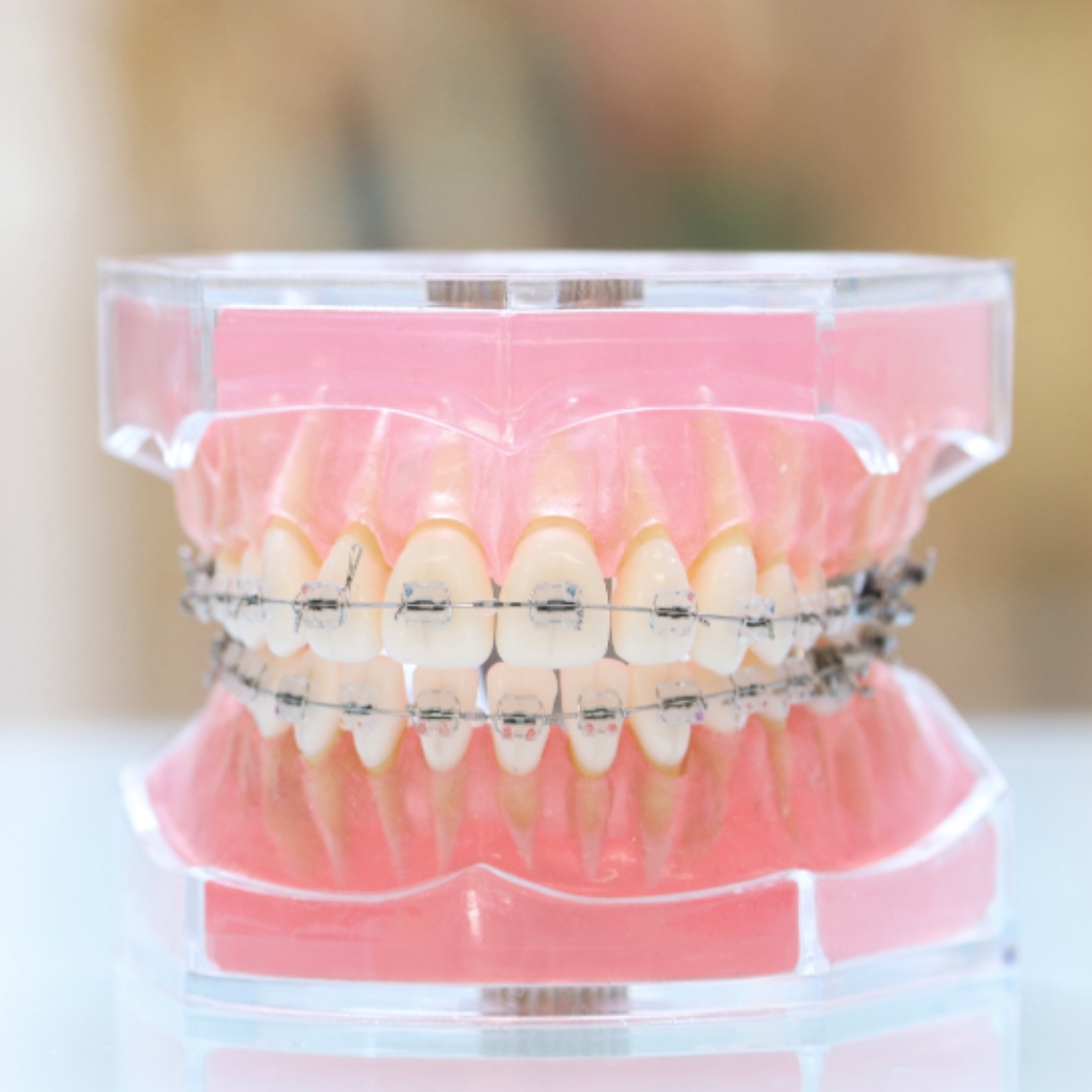 歯科医院で予防