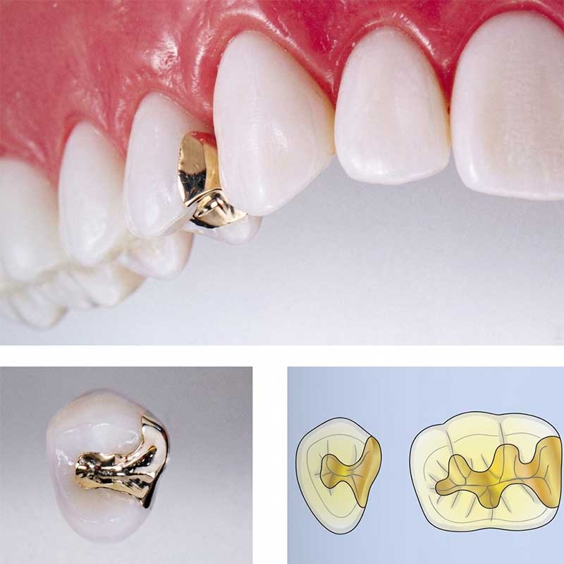 ゴールドインレー