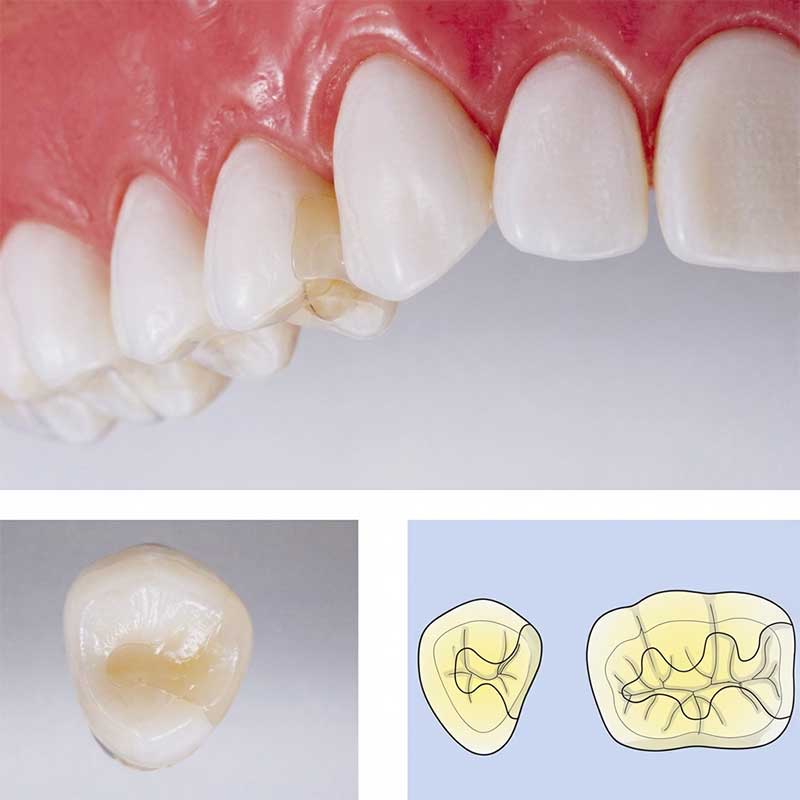 ハイブリッドセラミックインレー