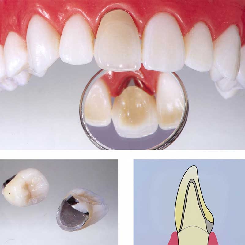 メタルボンドクラウン